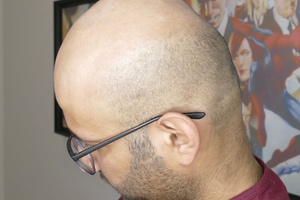 Исправление и удаление татуировки волос